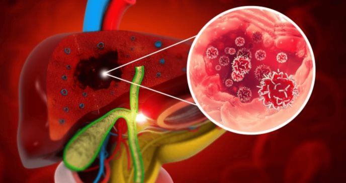 Hígado graso asociado a disfunción metabólica: Riesgo de cirrosis y enfermedad cardiovascular