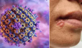 Herpes: el virus que causa úlceras labiales también puede infectar otras áreas del cuerpo