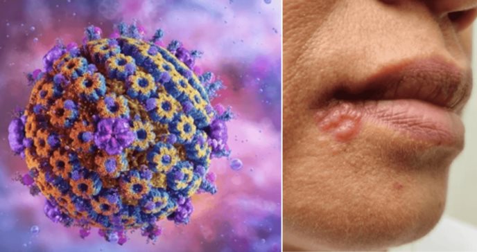 Herpes: el virus que causa úlceras labiales también puede infectar otras áreas del cuerpo