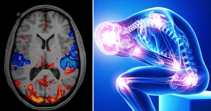 Migraña y fibromialgia: cómo la disfunción del sistema nervioso central amplifica el dolor crónico