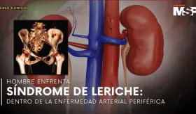 Hombre enfrenta síndrome de leriche: Dentro de la enfermedad arterial periférica