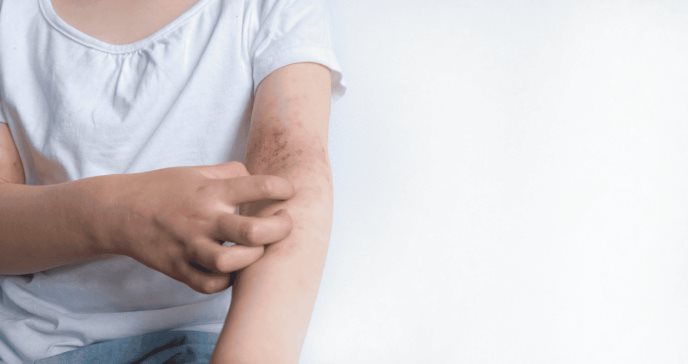 Aprueban tratamientos para dermatitis atópica: El medicamento biológico Nemluvio y la crema tópica Vtama