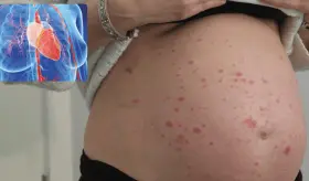 Mujeres embarazadas con psoriasis tienen mayor riesgo de preeclampsia y arritmias cardíacas: estudio