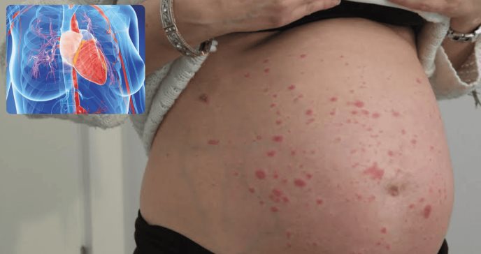 Mujeres embarazadas con psoriasis aumentan el riesgo de preeclampsia y arritmias cardíacas, según estudio