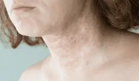 La inflamación crónica en la psoriasis aumenta riesgos cardiovasculares y autoinmunes