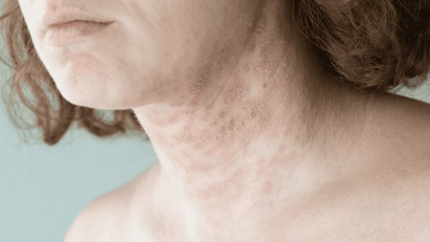 La inflamación crónica en la psoriasis aumenta riesgos cardiovasculares y autoinmunes La inflamación crónica en la psoriasis aumenta riesgos cardiovasculares y autoinmunes