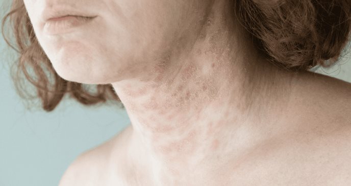 La inflamación crónica en la psoriasis aumenta riesgos cardiovasculares y autoinmunes