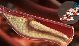 Esteroides para ganar masa muscular favorecerían el desarrollo de placas ateroscleróticas