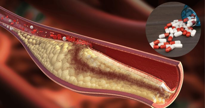 Esteroides para ganar masa muscular favorecerían el desarrollo de placas ateroscleróticas