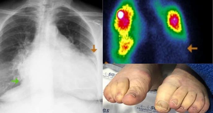 Diagnóstico y manejo de coma mixedematoso en paciente con hipotiroidismo e insuficiencia cardíaca