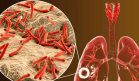 La tuberculosis se consolida como la enfermedad infecciosa más mortal del mundo, según la OMS
