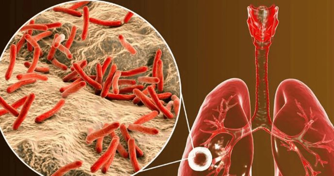 La tuberculosis se consolida como la enfermedad infecciosa más mortal del mundo, según la OMS