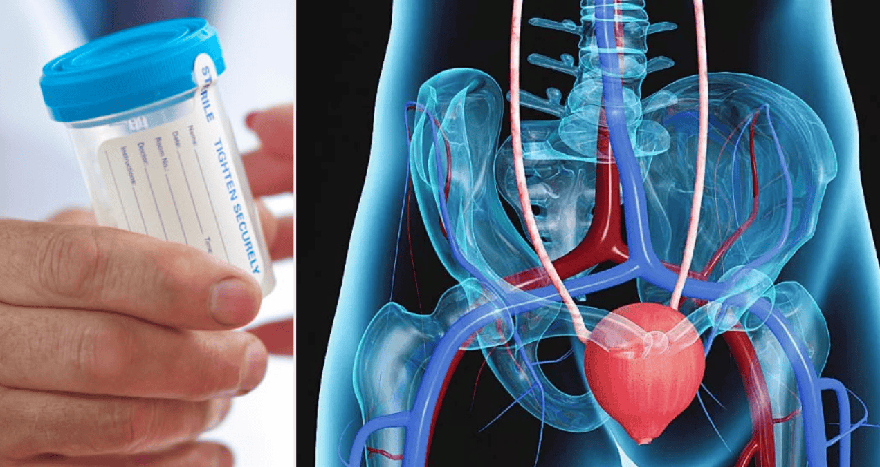 Nueva prueba urinaria muestra alta efectividad en la detección temprana del cáncer de vejiga