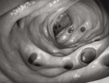 Desmienten que la diverticulosis no complicada se asocia con dolor abdominal y problemas intestinales