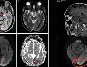 Hiperglucemia no cetósica causa convulsiones y degeneración neuronal en paciente de 68 años 