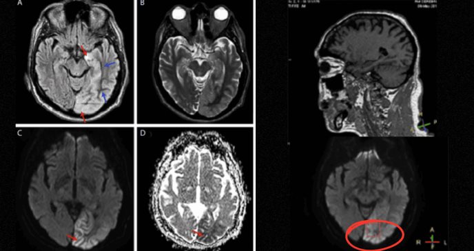 Hiperglucemia no cetósica causa convulsiones y degeneración neuronal en paciente de 68 años 