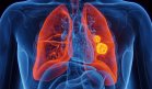 Nuevo tratamiento para adultos con cáncer de pulmón de células no pequeñas