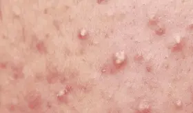 La FDA aprueba bimekizumab para el tratamiento de la hidradenitis supurativa moderada a grave en adultos