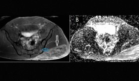 Diagnóstico de miositis y osteitis tras inyección no médica de esteroides anabólicos en hombre de 37 años