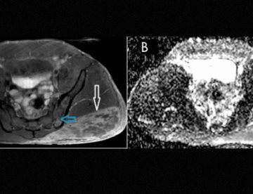 Diagnóstico de miositis y osteitis tras inyección no médica de esteroides anabólicos en hombre de 37 años