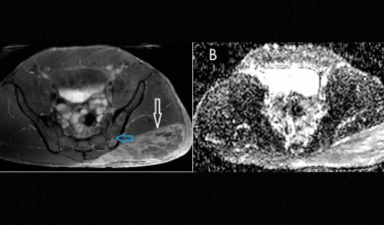 Diagnóstico de miositis y osteitis tras inyección no médica de esteroides anabólicos en hombre de 37 años