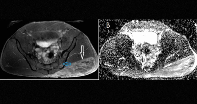 Diagnóstico de miositis y osteitis tras inyección no médica de esteroides anabólicos en hombre de 37 años