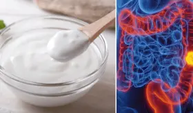 Consumo de yogur asociado a menor riesgo de tumores Bifidobacterium-positivos en colon