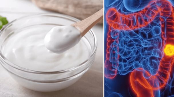 Consumo de yogur asociado a menor riesgo de tumores Bifidobacterium-positivos en colon Consumo de yogur asociado a menor riesgo de tumores Bifidobacterium-positivos en colon