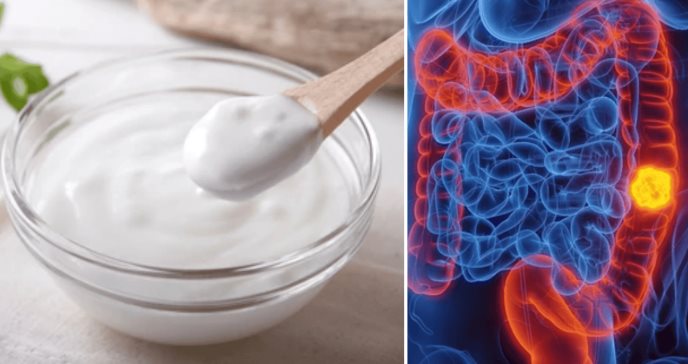 Consumo de yogur asociado a menor riesgo de tumores Bifidobacterium-positivos en colon