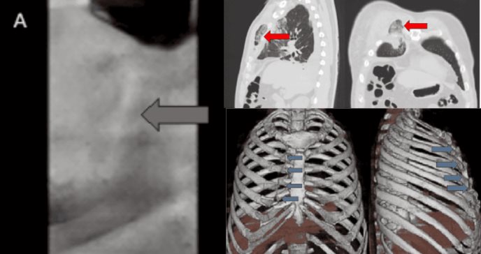 Detectan hernia pulmonar espontánea en hombre de 59 años con fracturas costales y hemoptisis