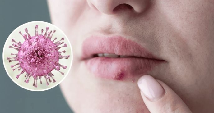 Descubren cómo el virus del herpes simplex elude los medicamentos: Avances en la resistencia viral