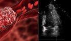 Identifican riesgo de trombo ventricular izquierdo tras infarto por fracción de eyección y ST elevado