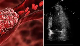 Identifican riesgo de trombo ventricular izquierdo tras infarto por fracción de eyección y ST elevado