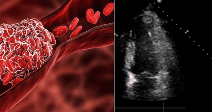 Identifican riesgo de trombo ventricular izquierdo tras infarto por fracción de eyección y ST elevado