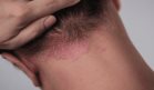 Desmitificando 8 mitos sobre la psoriasis: ¿Es contagiosa? ¿Es solo piel seca? Lo que necesitas saber