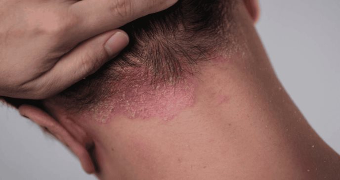 Desmitificando 8 mitos sobre la psoriasis: ¿Es contagiosa? ¿Es solo piel seca? Lo que necesitas saber