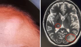 Cryptococcus neoformans se manifiesta atípicamente con lesiones subcutáneas e intracerebrales
