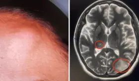 Cryptococcus neoformans se manifiesta atípicamente con lesiones subcutáneas e intracerebrales