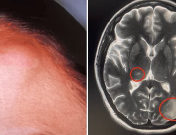 Cryptococcus neoformans se manifiesta atípicamente con lesiones subcutáneas e intracerebrales