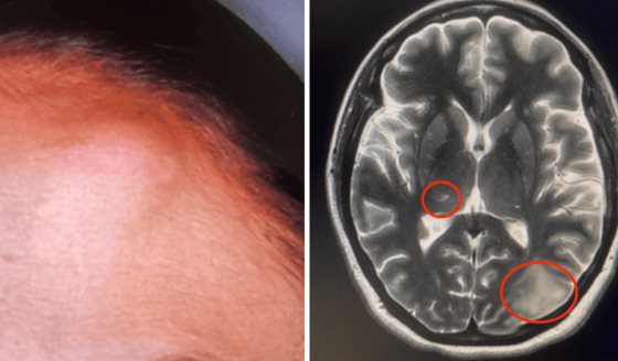 Cryptococcus neoformans se manifiesta atípicamente con lesiones subcutáneas e intracerebrales
