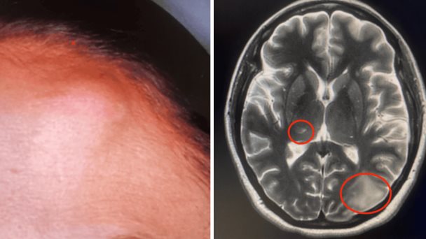 Cryptococcus neoformans se manifiesta atípicamente con lesiones subcutáneas e intracerebrales Cryptococcus neoformans se manifiesta atípicamente con lesiones subcutáneas e intracerebrales