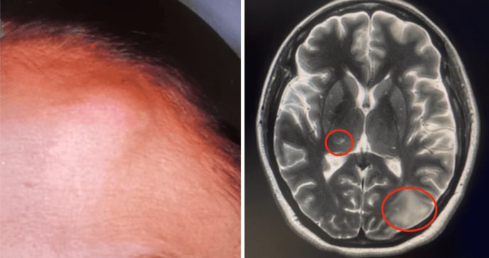 Cryptococcus neoformans se manifiesta atípicamente con lesiones subcutáneas e intracerebrales