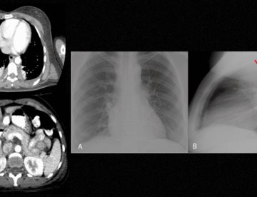 Fiebre alta, erupción rosada y dolor articular lleva a diagnóstico de Enfermedad de Still en adultos