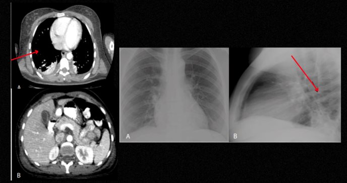 Fiebre alta, erupción rosada y dolor articular lleva a diagnóstico de Enfermedad de Still en adultos