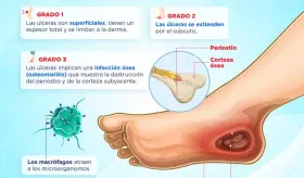 ÚLCERA DEL PIE DIABÉTICO
