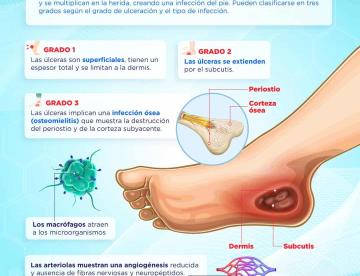 ÚLCERA DEL PIE DIABÉTICO