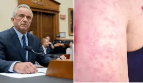 Tratamientos no convencionales para el sarampión: Kennedy Jr., promueve vitamina A y aceite de bacalao 