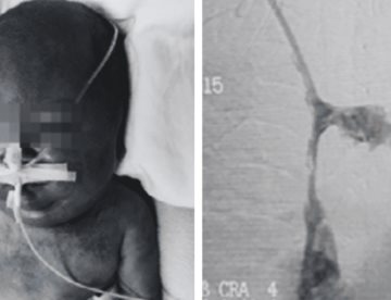 Neonato presentó síndrome de vena cava superior por trombosis tras 90 días de catéter venoso central