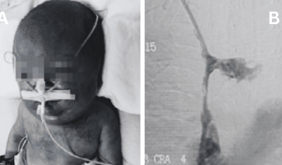 Neonato presentó síndrome de vena cava superior por trombosis tras 90 días de catéter venoso central
