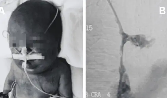 Neonato present&oacute; s&iacute;ndrome de vena cava superior por trombosis tras 90 d&iacute;as de cat&eacute;ter venoso central